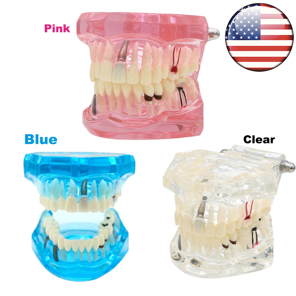 Dental Model Implant Disease Teeth Repair Restoration Bridge Dentist Teaching