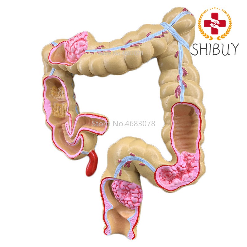 Colorectal Lesion Model Colon Large Intestine Pathological Model 14x17x21cm