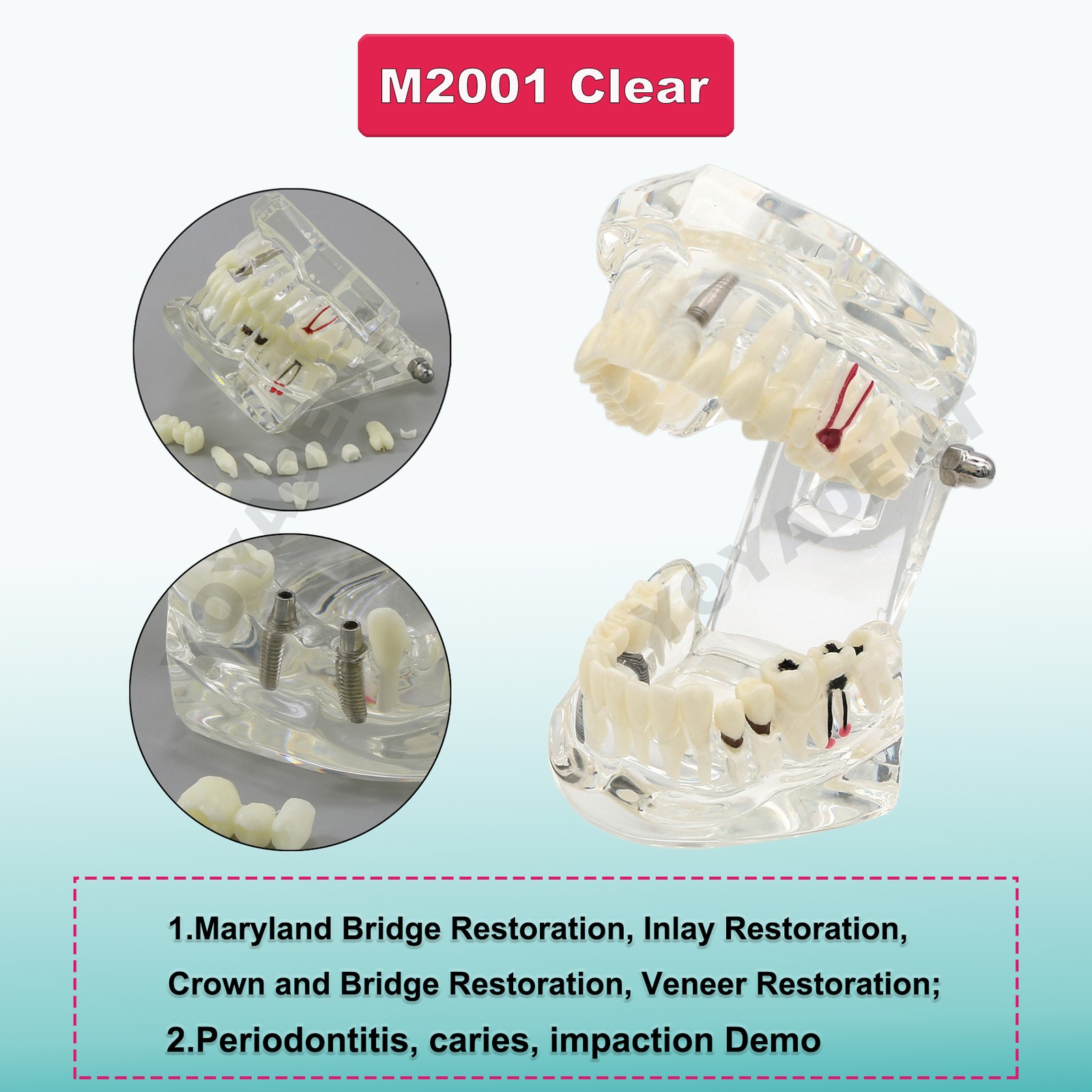 Dental Teeth Model Upper Lower Jaw 4 Overdenture Practice Implant Typodont Demo