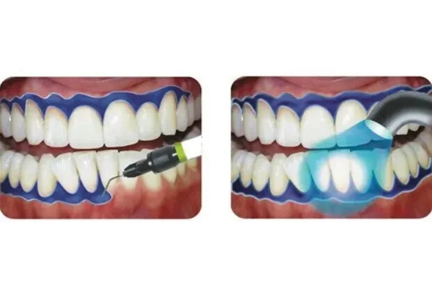 Dental GINGIVA SHIELD VLC Light Curing Gingival Resin barrier, Blue 4 x 2g Pack