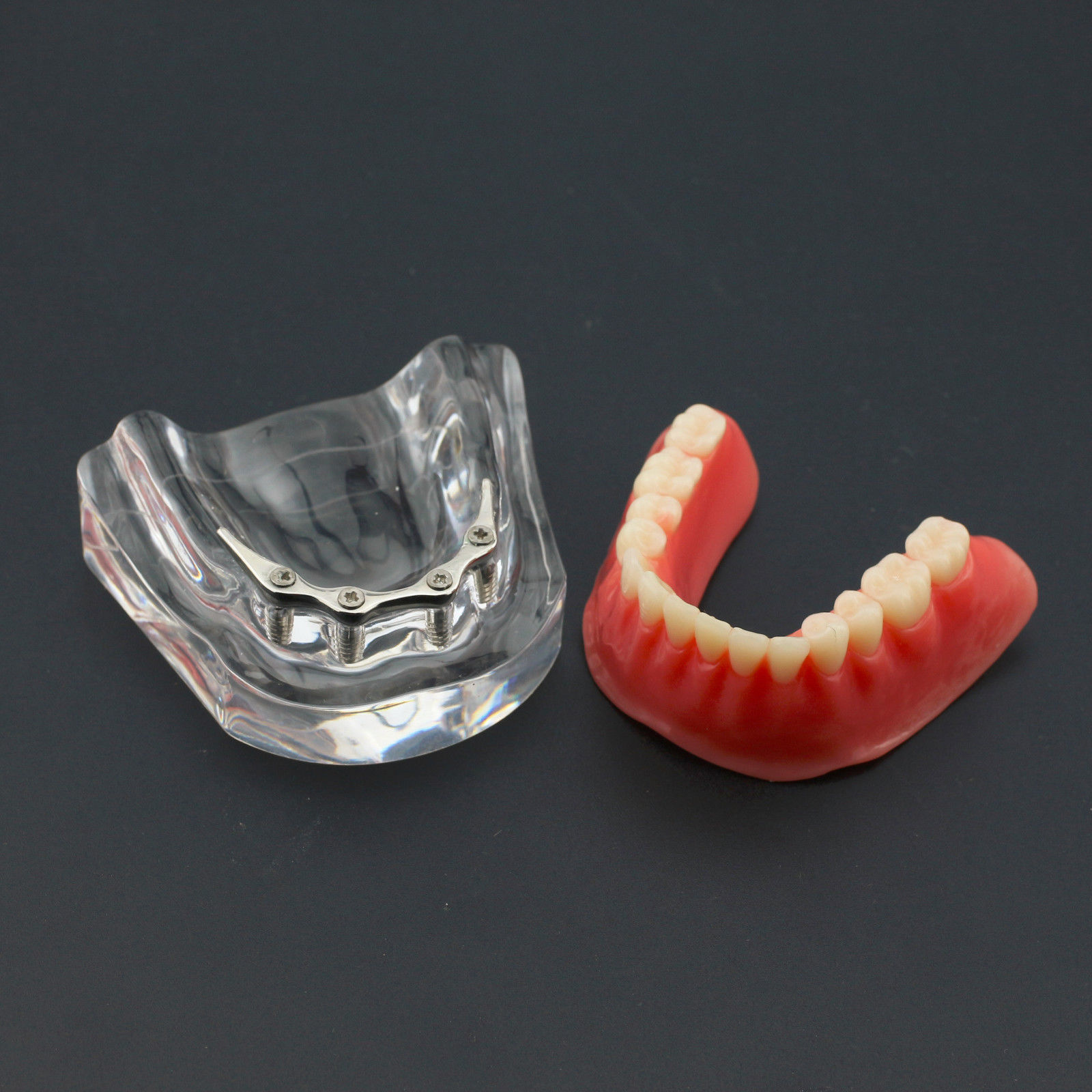 Dental Implants Restoration Model Overdenture Inferior With Demo Teaching Study
