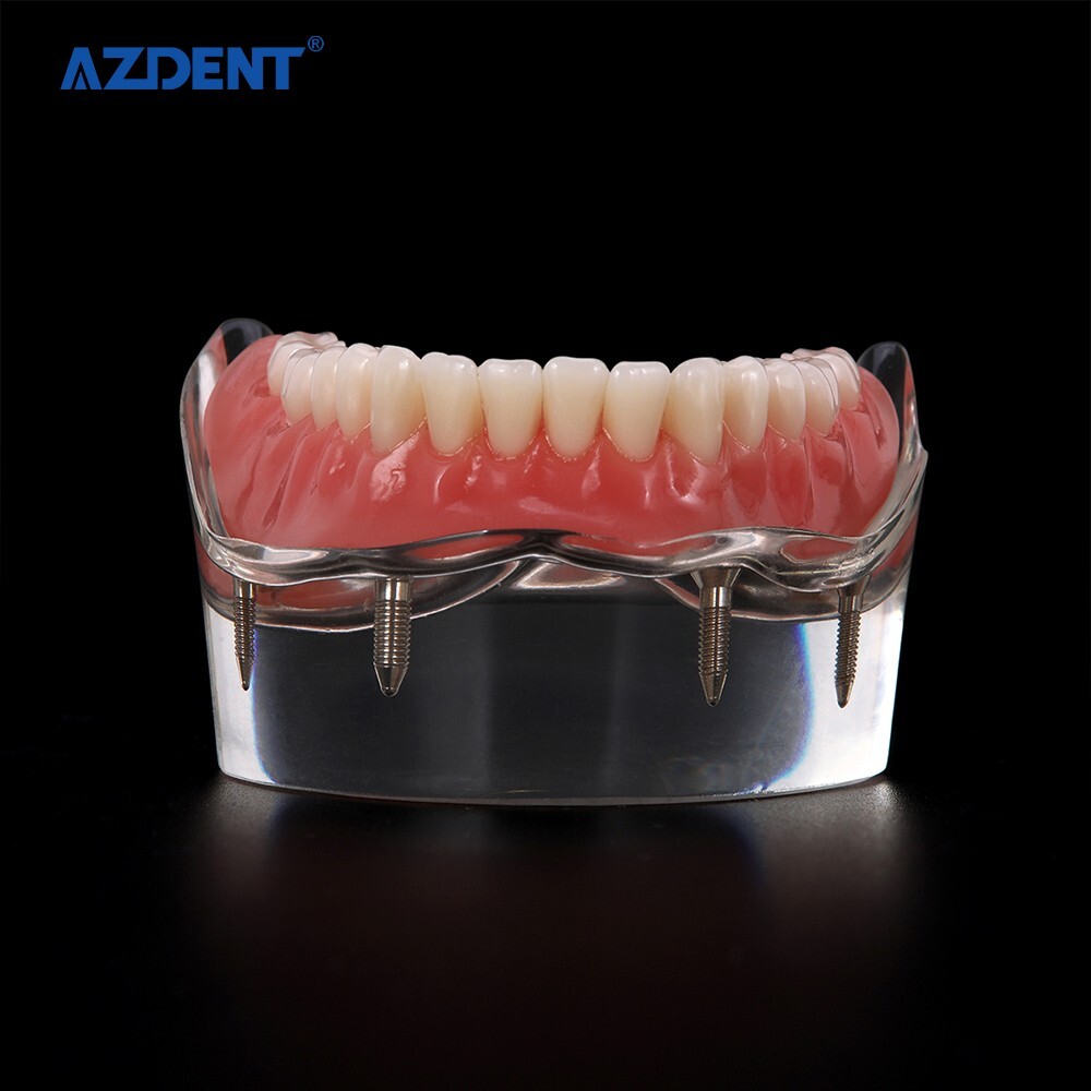 Dental Demonstration 4 Implants Teeth Model Typodont Inferior Overdenture Lower