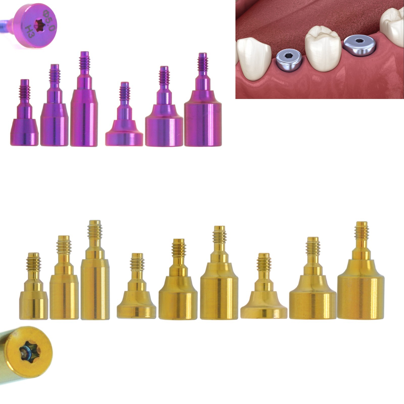 US Nobel Biocare Hex Implant for NP/RP Healing/locator Abutment Analog Scan Body