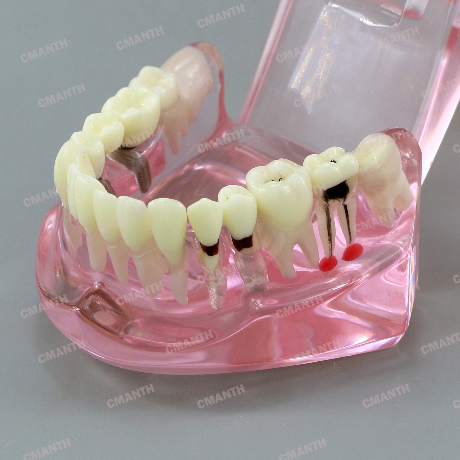 Dental Teeth Model Ortho Implant Practice Teaching of Implants Demo Model
