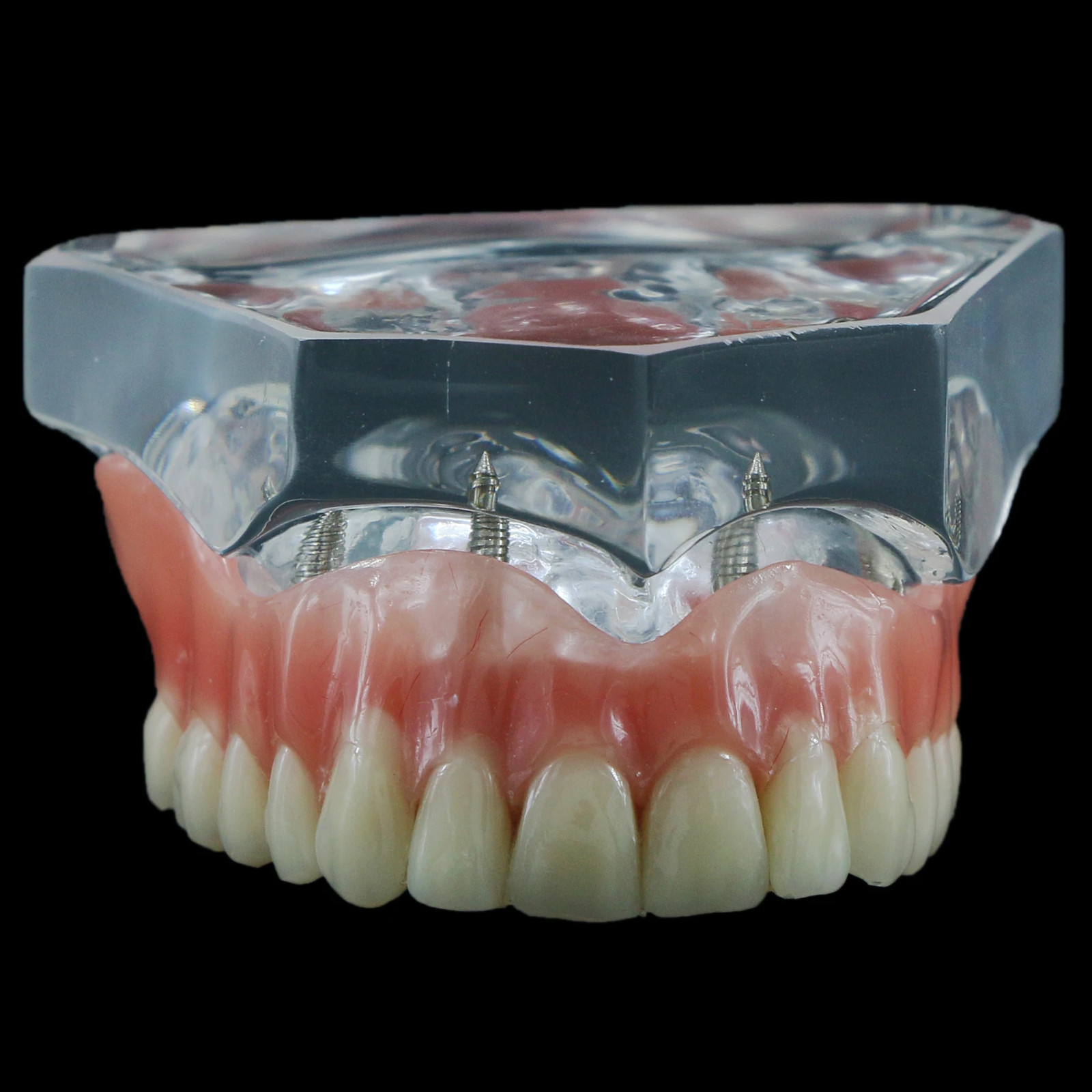 For Upper/Lower Teaching Study Dental Implant Model, Removable Overdenture