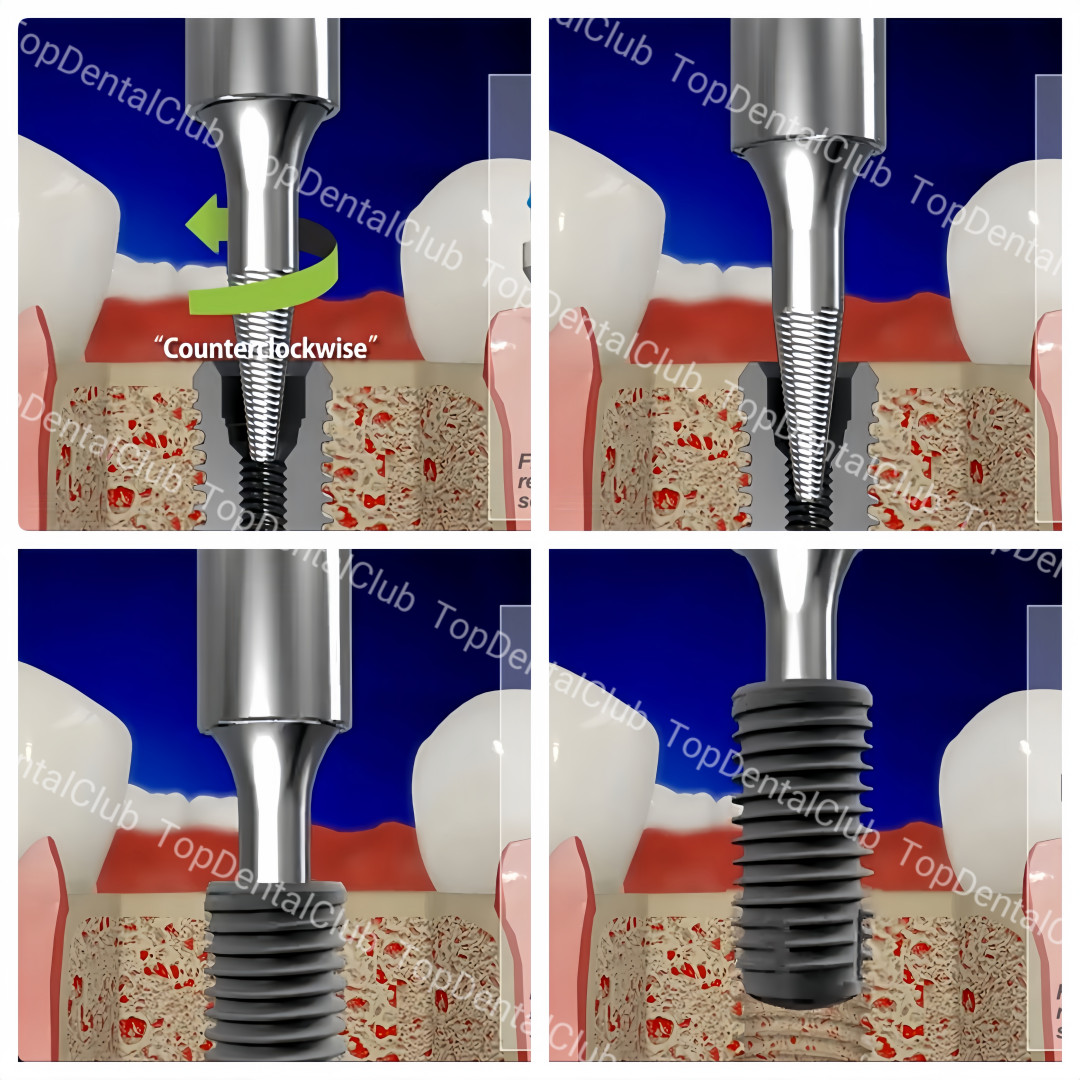Dental Fixture Remover Screw Broken Implants Pick Up Extractor Failed SOS Screws