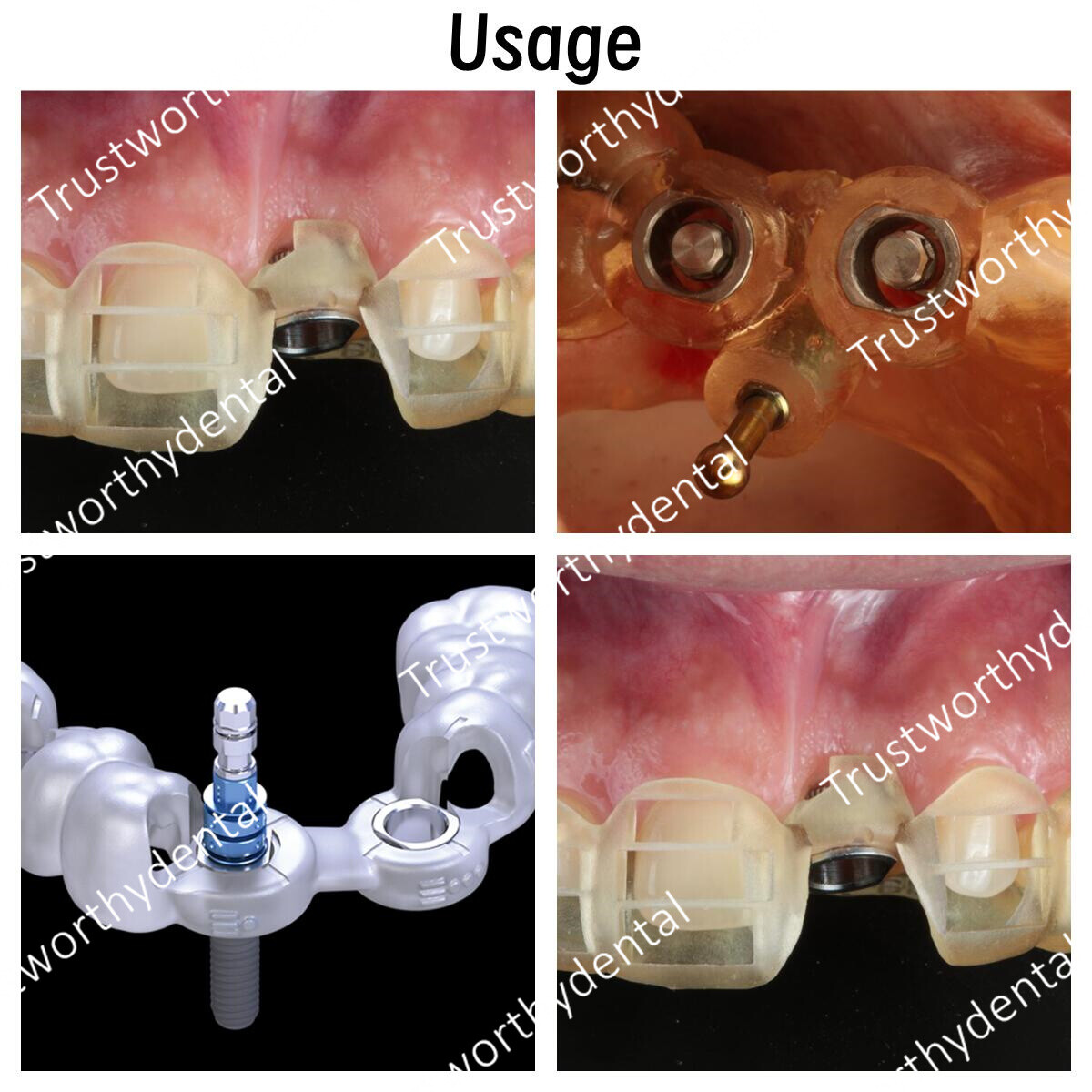 10x Dental ITI Guide Hole Sleeve Implant Digital Guidance DGS Straumann ∅5.0/2.2