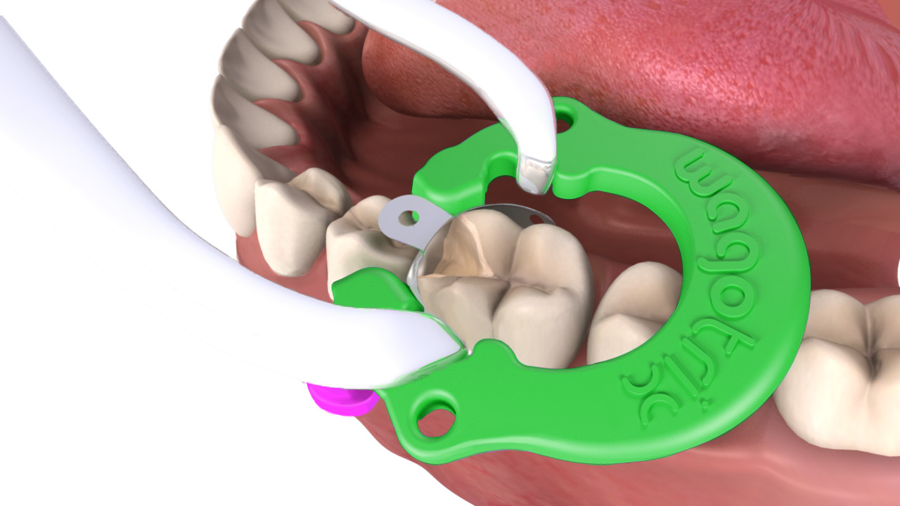 Sectional Matrix System, Dental Rings – Wagotrix Universal Matrix Rings – Qty 35