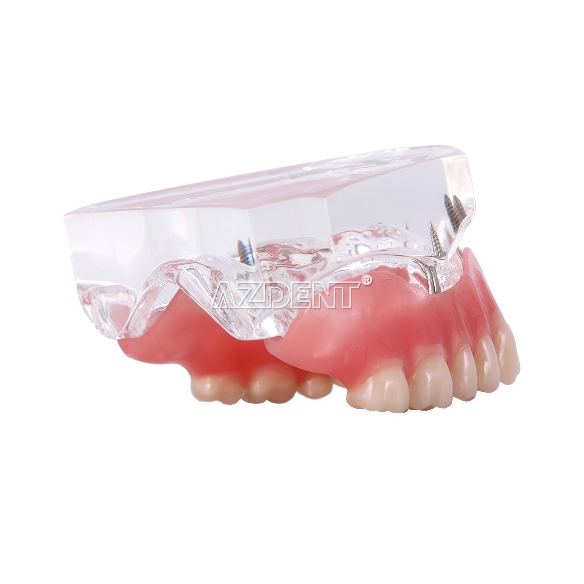 Dental Implant Teeth Model Demo Overdenture Restoration With Implants Lower 6003