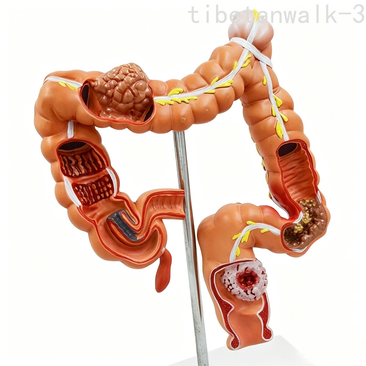Colon Disease Model Large Intestine Appendix Pathology Model