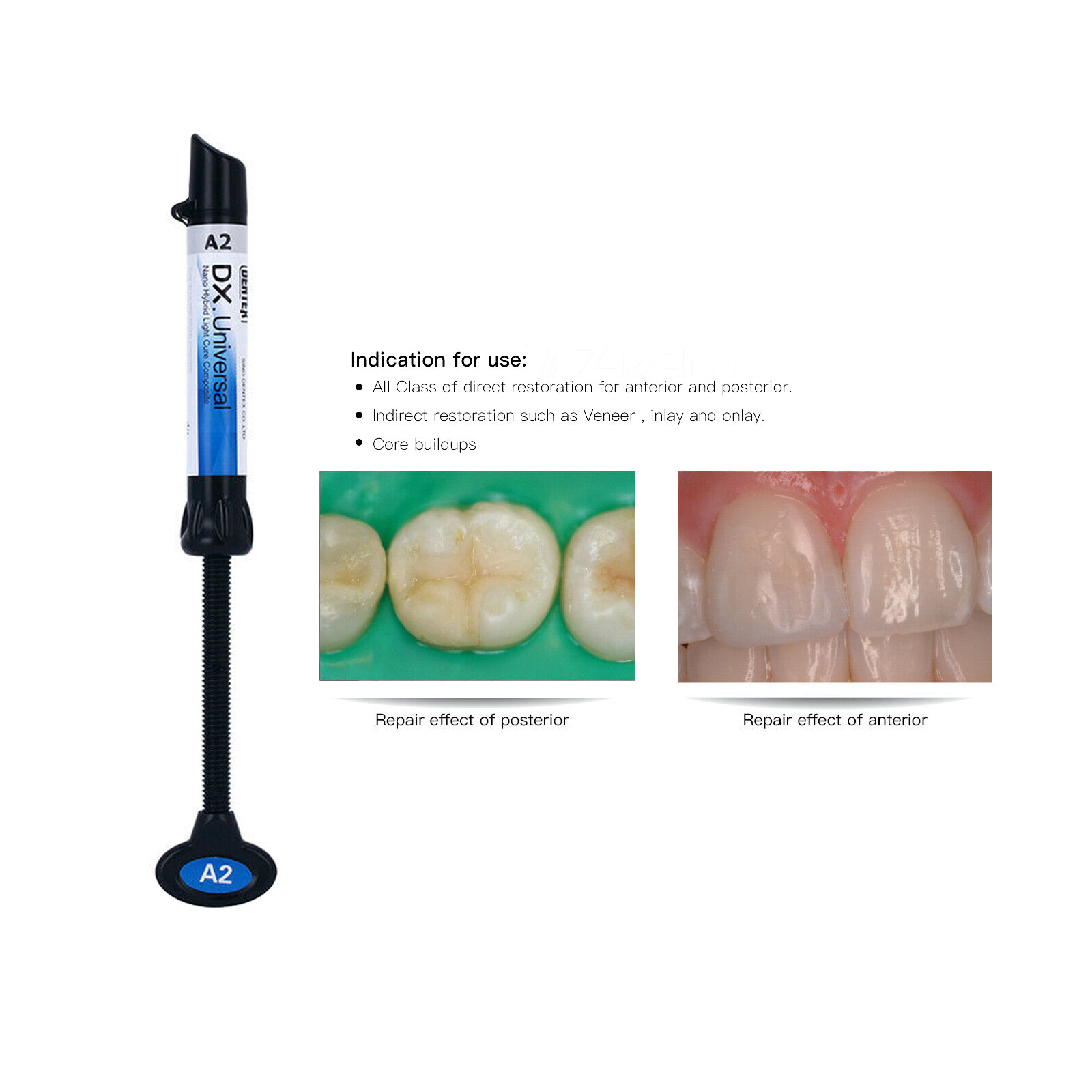 DX Dental Universal Light Cure Composite Resin A1,A2,A3,A3.5,B1 Shade 4g/Syringe