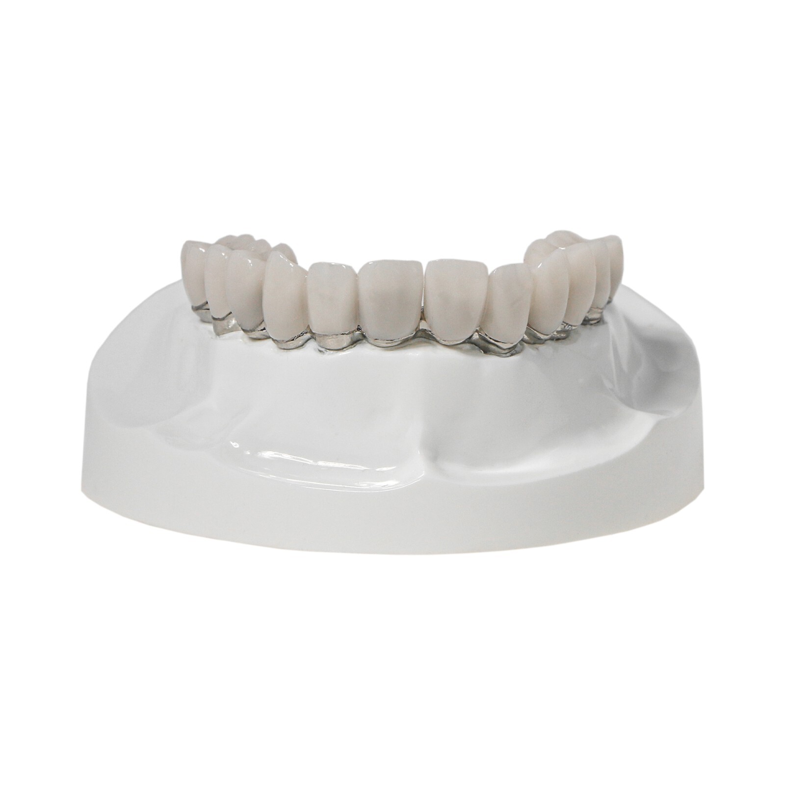 Implants Dental All-on-4 Overdenture Model Upper Jaw Restoration 4 Screws M6023