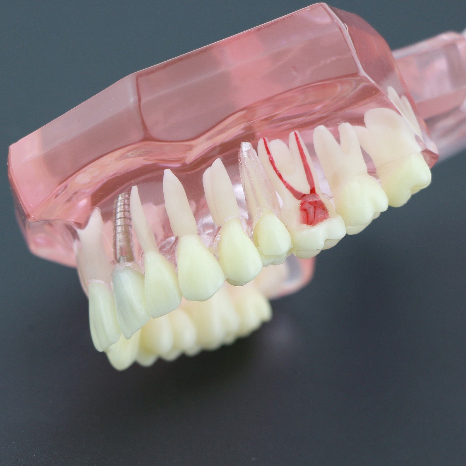 Dental Implant Teeth Model Teach Study Demo Restoration Pathology #2001 Pink