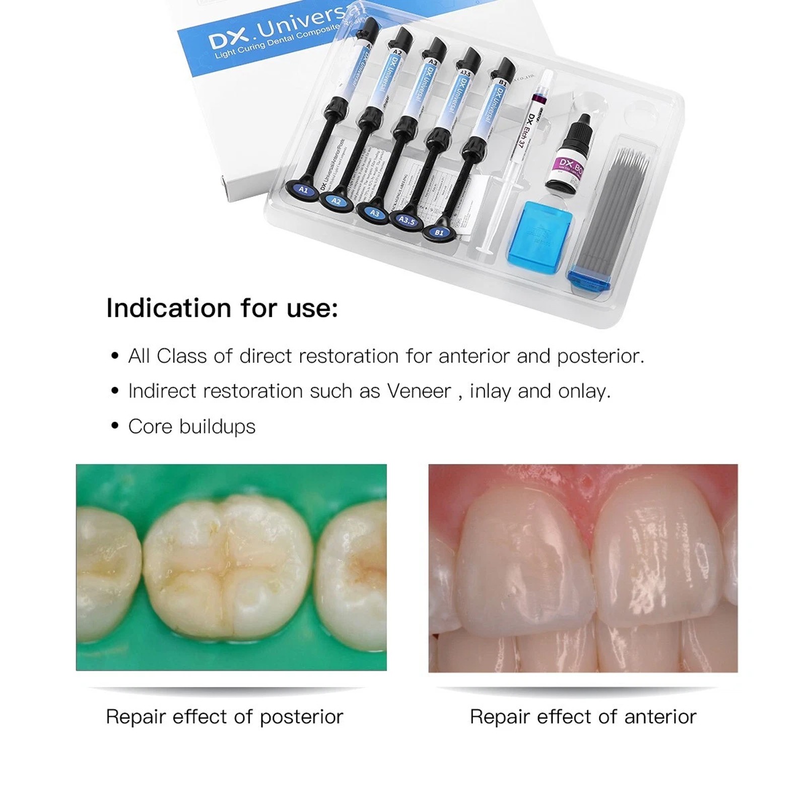 Kit de resina de compuesto de cura dental Dentex Light Shade A1 A2 A3 A3.5 B1