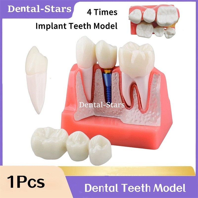Dental Implant Model 4 Times Analysis Crown Bridge Removable Demonstration Model