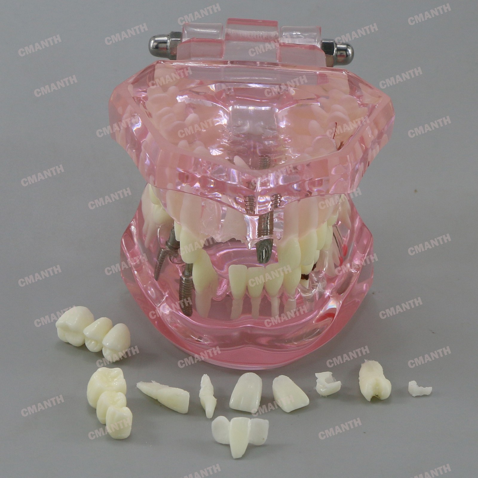 Dental Teeth Model Ortho Implant Practice Teaching of Implants Demo Model