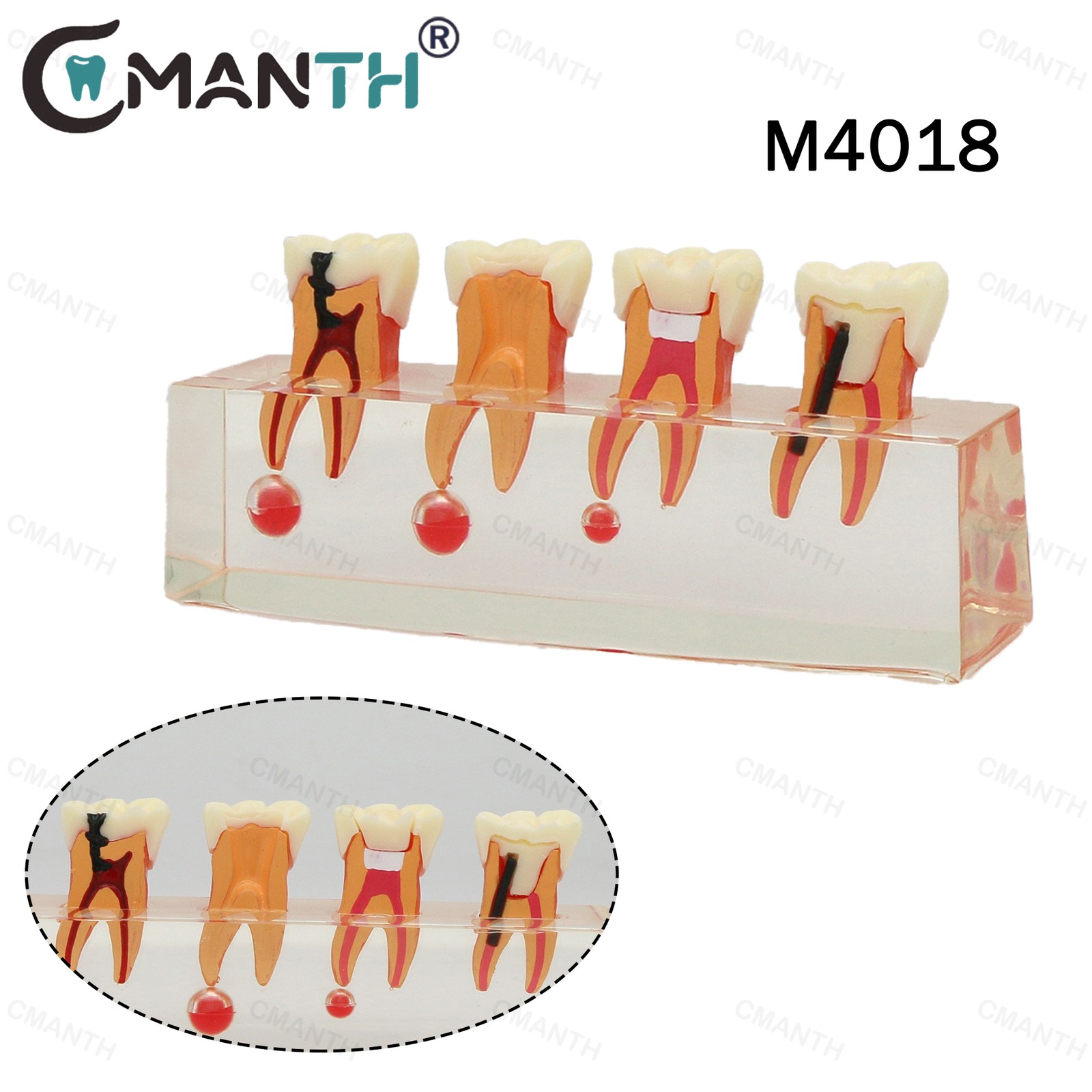 US Dental Teeth Model 4-Stage Molar Root Canal Caries Endodontic Treatment Study
