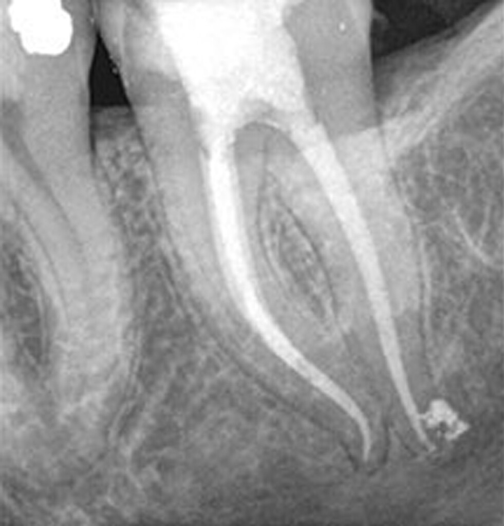 ORIGINAL WaveOne Gold Primary 25mm Endodontic Root Canal 6 Files. READ.