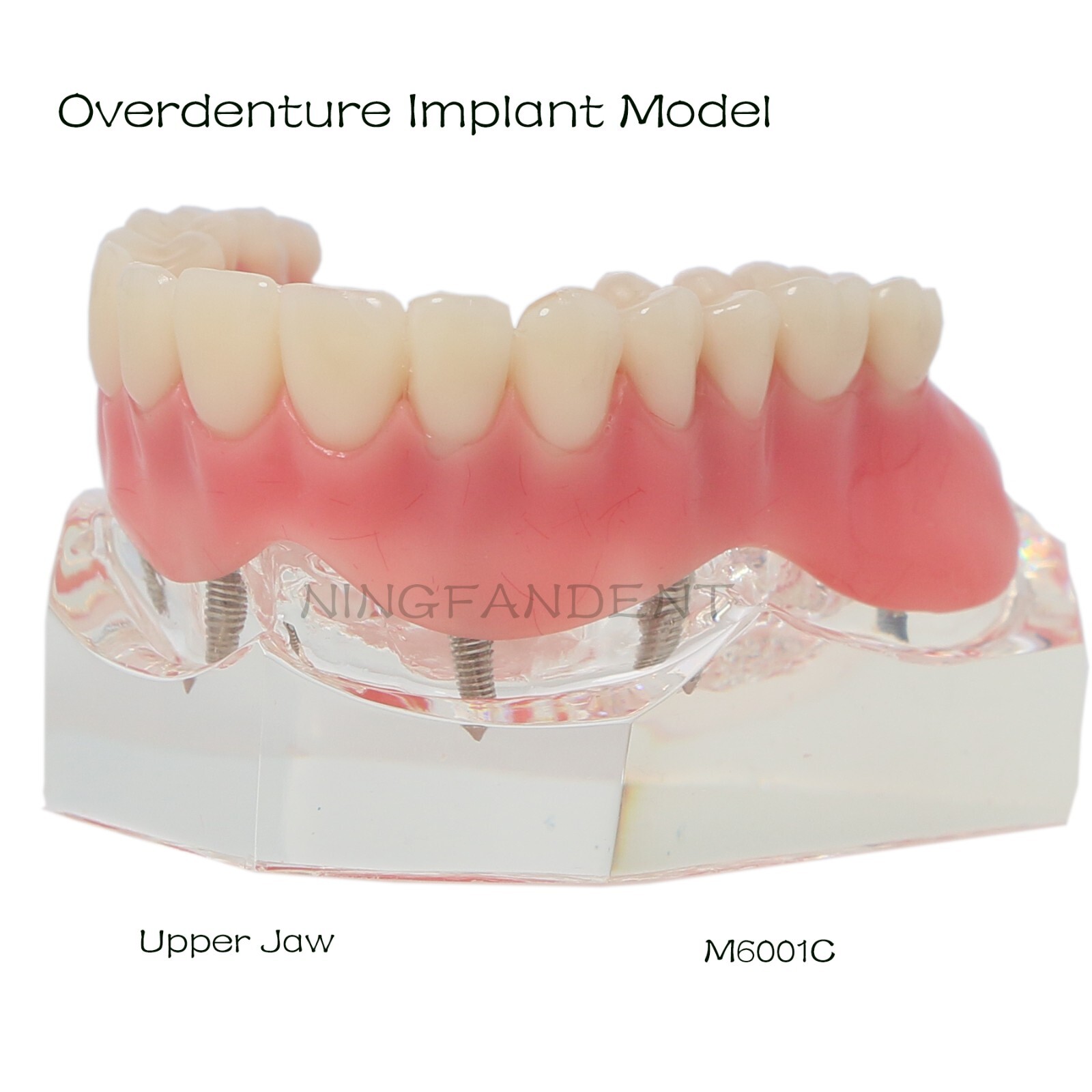 Dental Implant Demo All-on-4 Overdenture /PRD/Anatomical/Treatment Repair Model