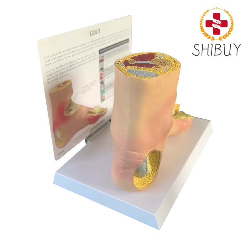 Diabetes Target Organ Model Pain Wind Stone Foot Complication Model