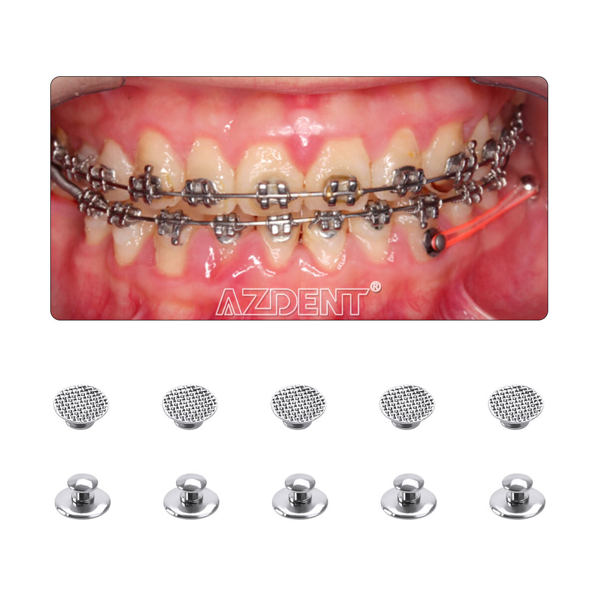 100pcs Dental Orthodontic Lingual Buttons Round Mesh Base Bondable Metal