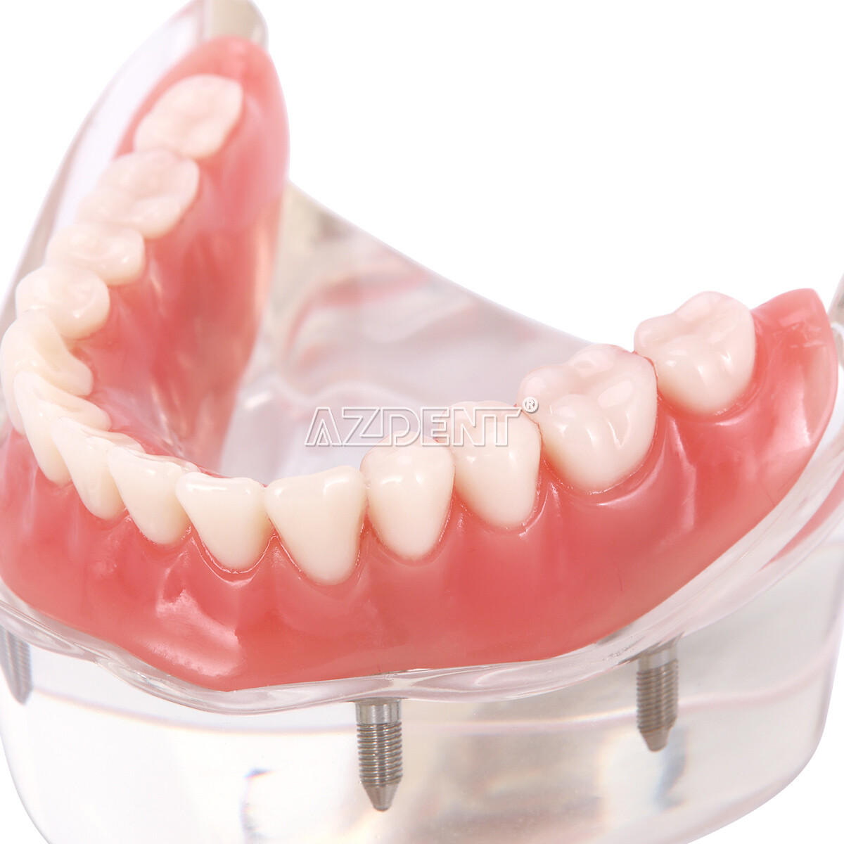 Dental Demonstration 4 Implants Teeth Model Typodont Inferior Overdenture Lower