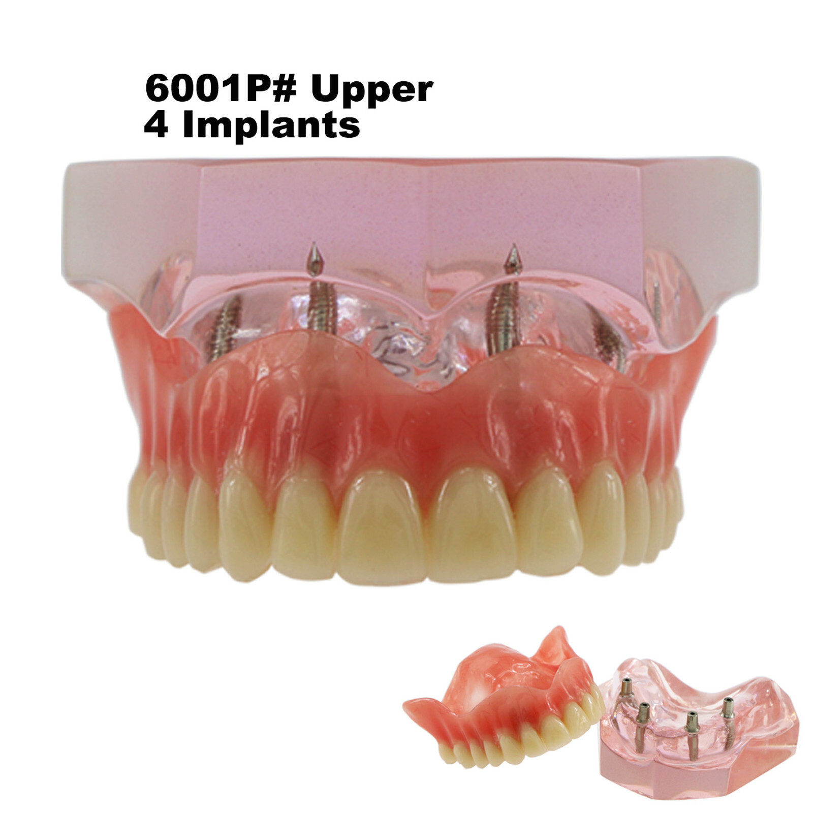 Dental Teeth Model 2 4 Implant Overdenture Typodont Restoration Demo Upper Lower