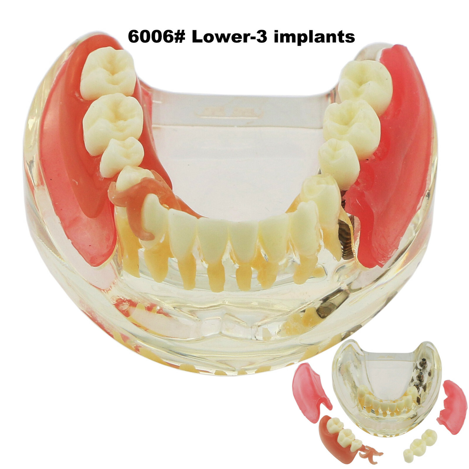 Dental Teeth Model 2 4 Implant Overdenture Typodont Restoration Demo Upper Lower
