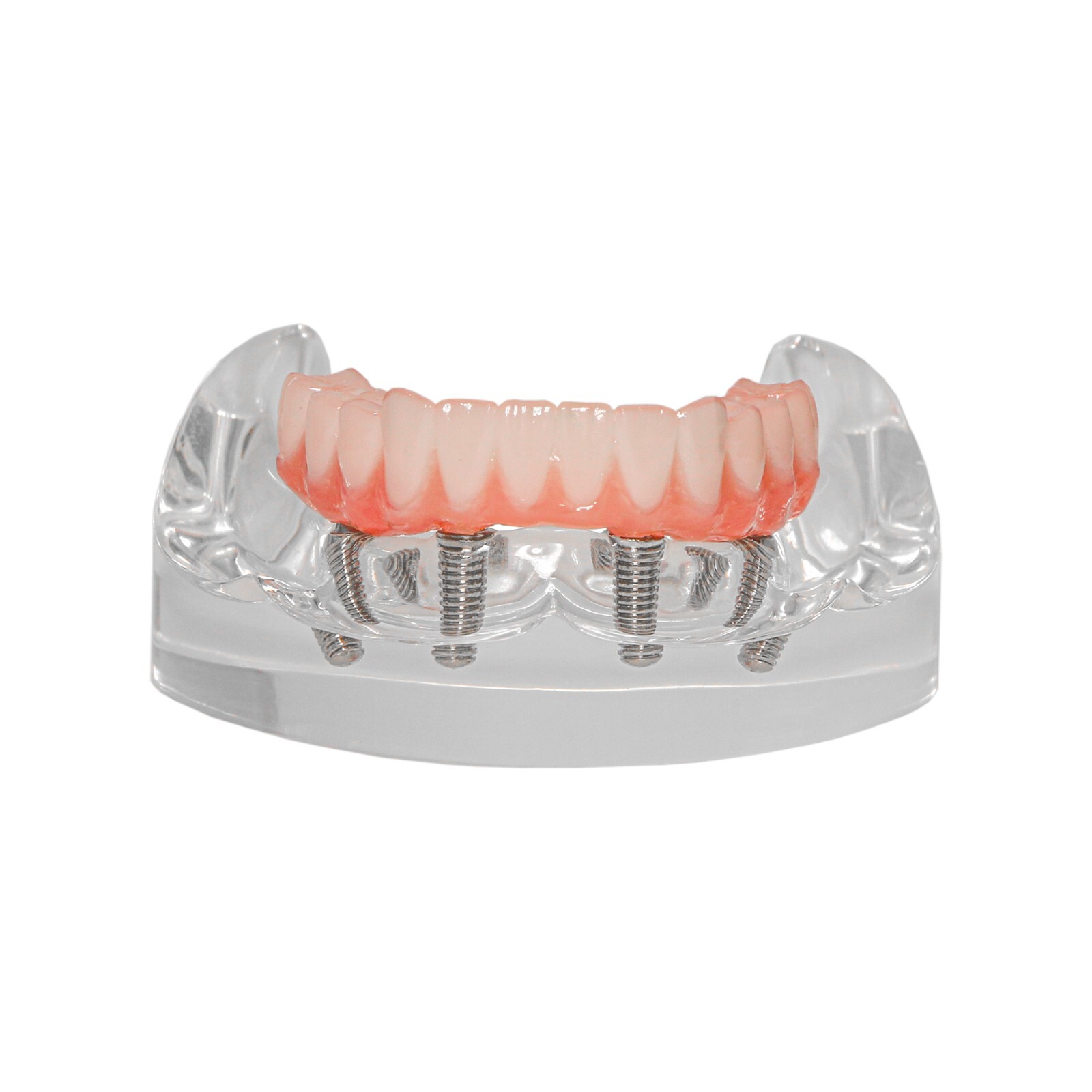 Dental All-on-4 Overdenture Implant Model, Upper/Lower Jaw-Clear,With 4 Screw