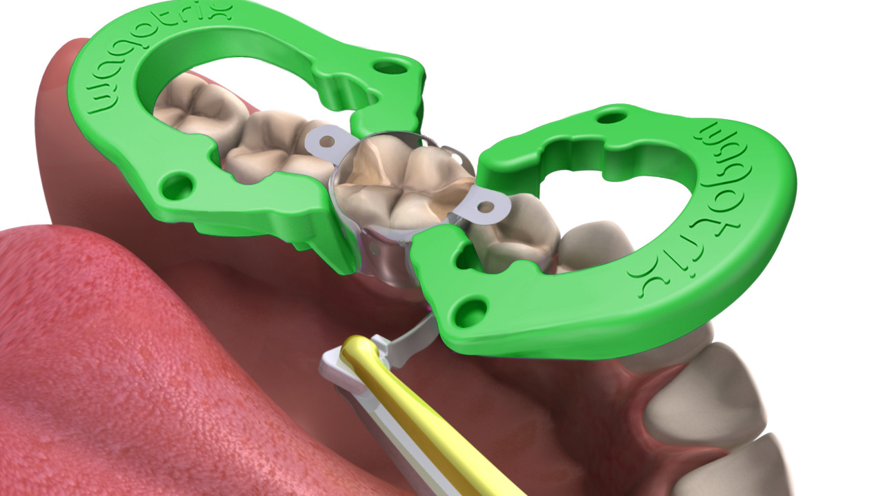 Sectional Matrix System, Dental Rings – Wagotrix Universal Matrix Rings – Qty 35