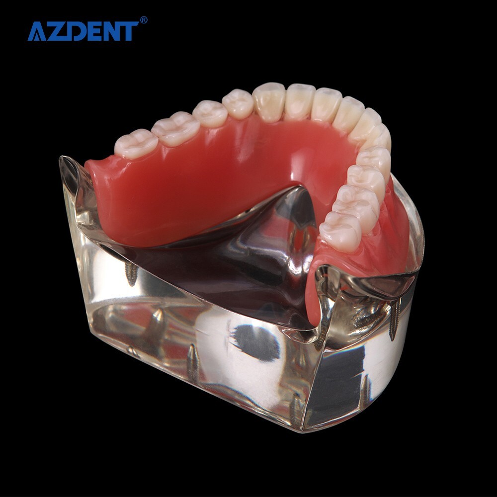 Dental Demonstration 4 Implants Teeth Model Typodont Inferior Overdenture Lower