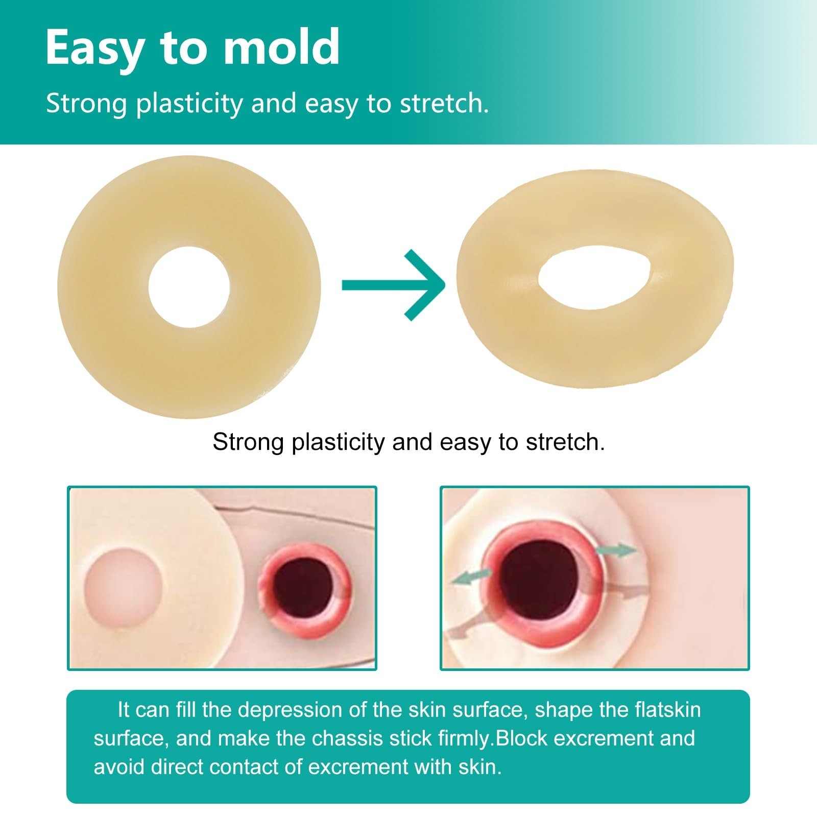 Ostomy Barrier Rings – Outer Diameter 2″ (50mm) 4mm Thickness,Moldable Ostomy…