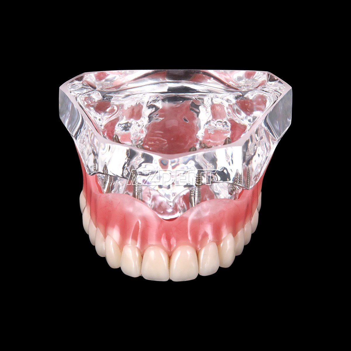 Dental Implant Teeth Model Demo Overdenture Restoration With Implants Lower 6003