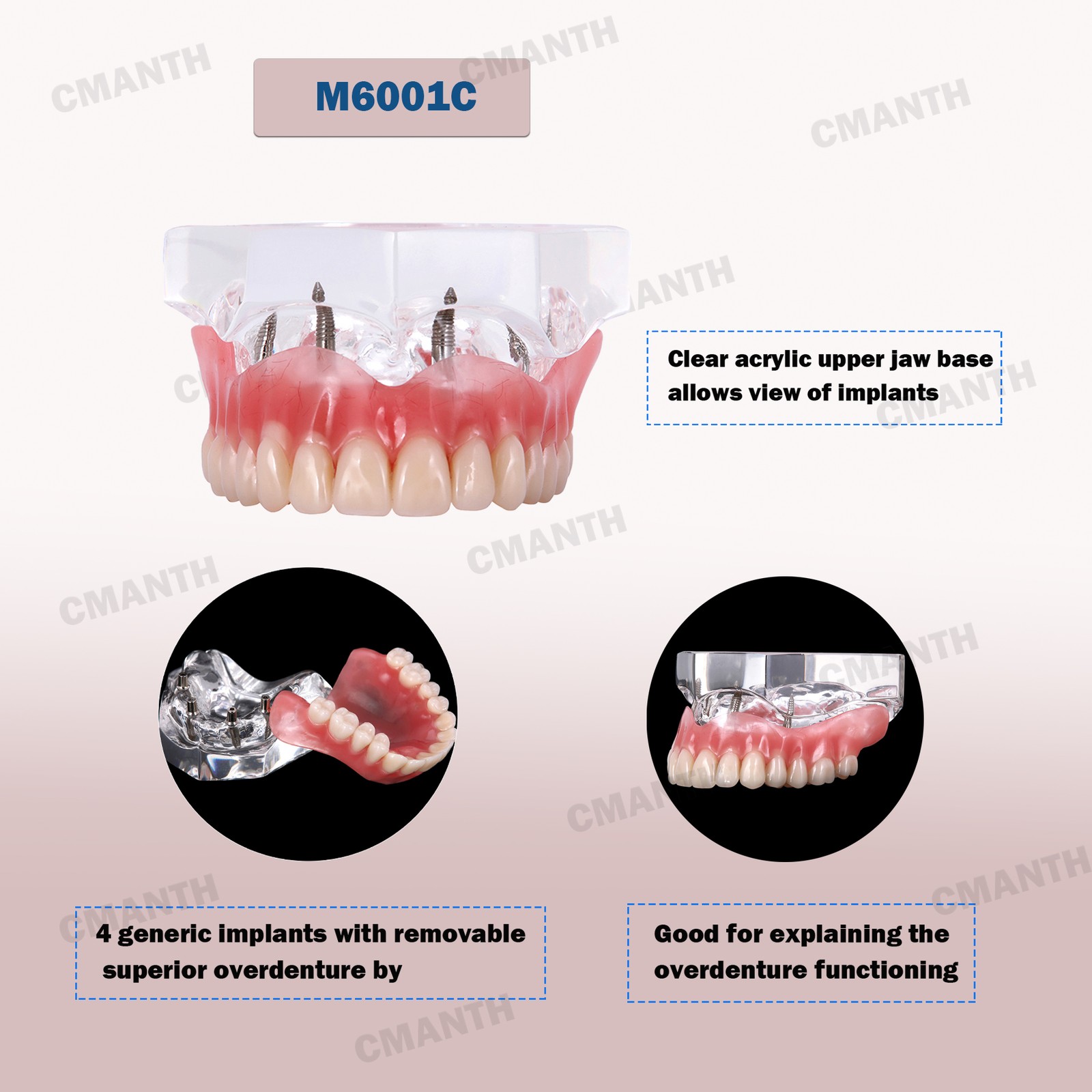 Dental Implant Overdenture Restoration Model Upper/Lower Typodonts Implant Demo