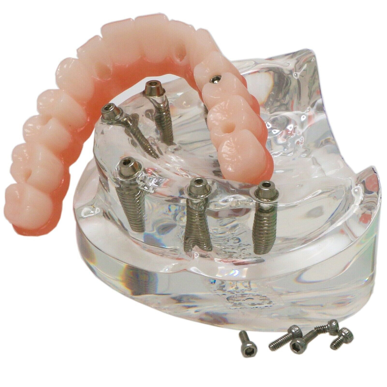 US Dental Implant Restoration Model Upper Jaw 6 Screws Post Core Bridge M6001-2